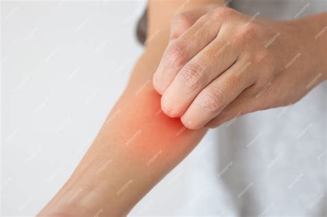 Pele Aspera E Coçando - Jovem asiático coçando e coçando o braço por causa da dermatite de ...