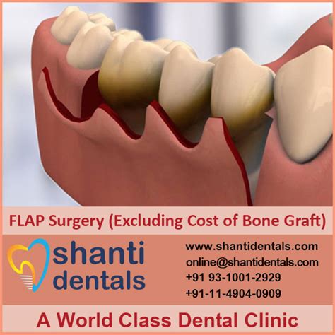 FLAP Surgery (Excluding Cost of Bone Graft) - Shanti Dentals