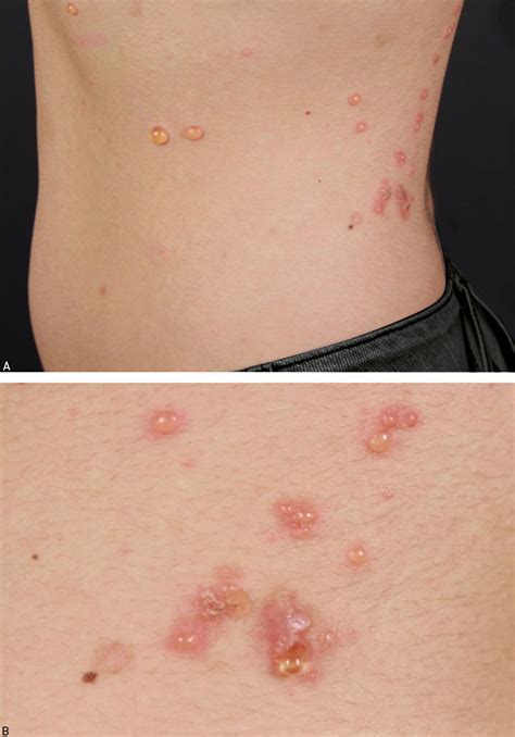 Adult linear IgA bullous dermatosis: report of three cases* | Anais