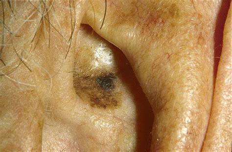 Лентиго меланома фото – 29 шт. / fotodiagnoz.com