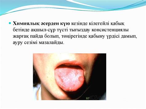 Лейкоплакия. Жазық лейкоплакия - презентация онлайн