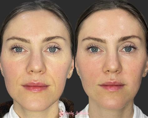 Smile Lift Treatment With Fillers - Benefits, Costs, Results ...
