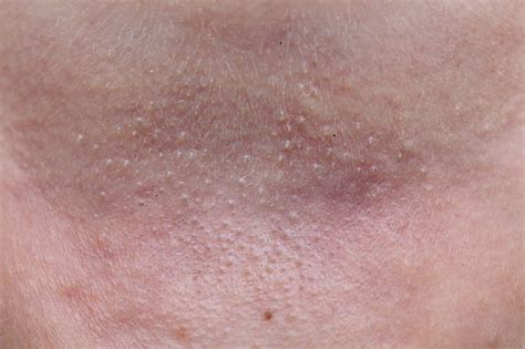 Miliaria - Wat is het? Welke vormen zijn er? - Simpto.nl