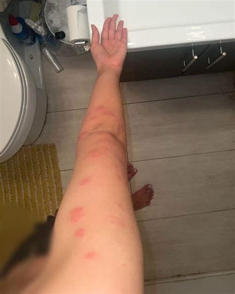 How To Identify 10 Of The Most Common Bug Bites – Read This Story