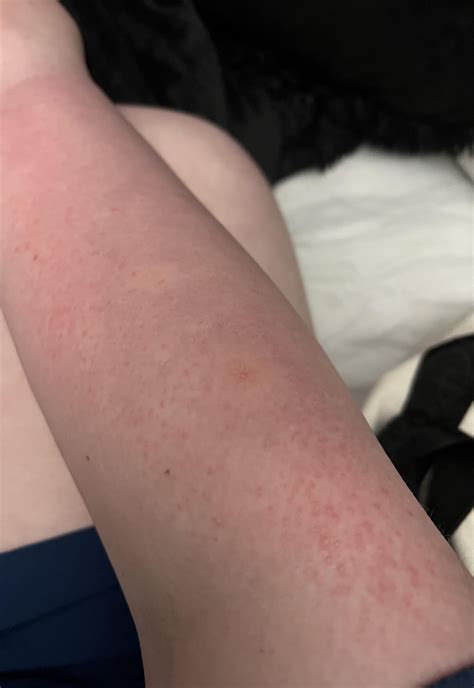 Does this look like Pmle or sun allergy ? (Don’t mind my skin I have