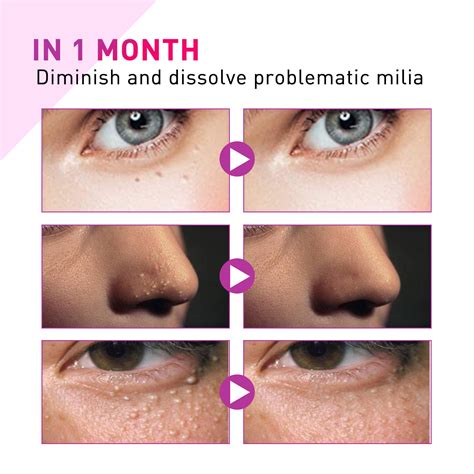 Milia Spot Treatment Helps Dissolve and Reduce Milia, Milia Remover ...