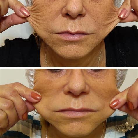 Bioestimulador Antes E Depois - Bioestimulador de colágeno - Royal Face | Clínica de Estética
