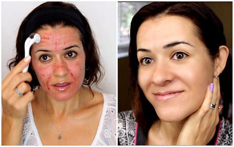 Dermaroller Antes E Depois