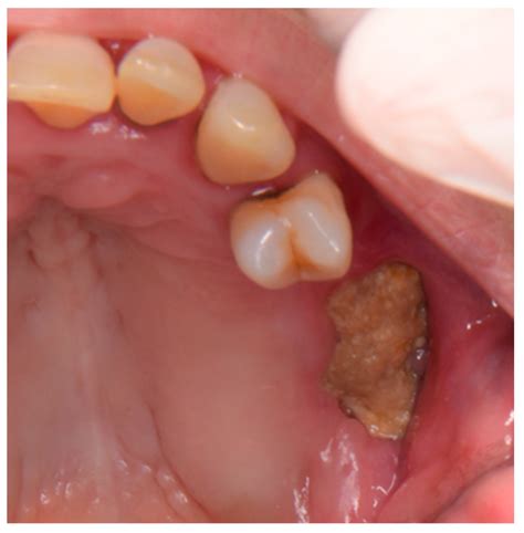 Dentistry Journal | Free Full-Text | Multiple-Drugs-Related ...
