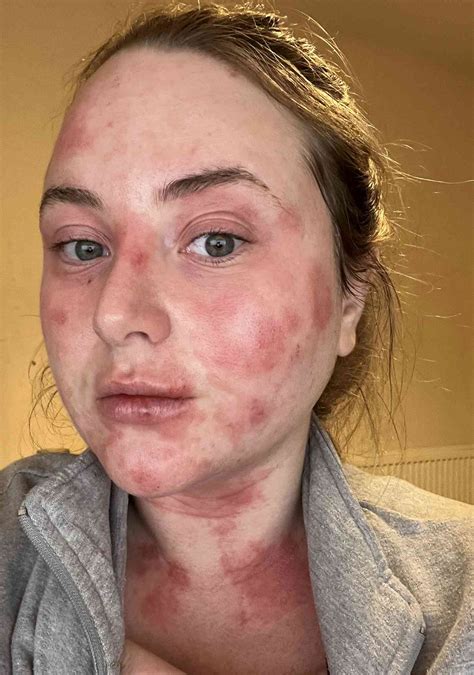 Woman Breaks Out in 'Elephant Skin' from Dental Veneers