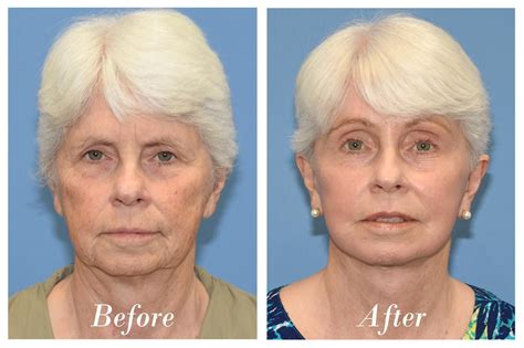 C02 Laser Skin Resurfacing Before & After 01 | VIP