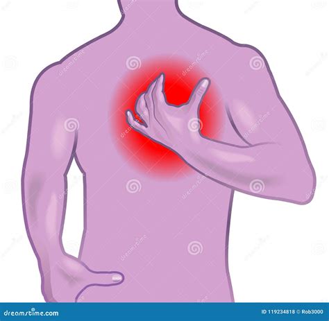 Sintomi Di Infarto Intestinale 2
