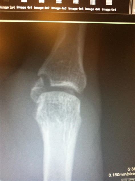 time   avulsion fracture mtbrcom