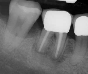 root  resection specialist practice dr dr mathy colleagues