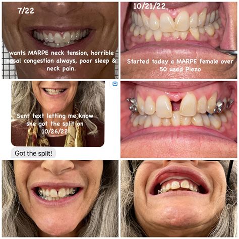 Maxillary Skeletal Expansion (MSE) | Dentist Arlington, VA