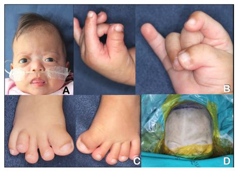 Sindrome Pfeiffer Aspettative Di Vita 10