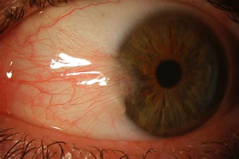 sore eyes gp eyes