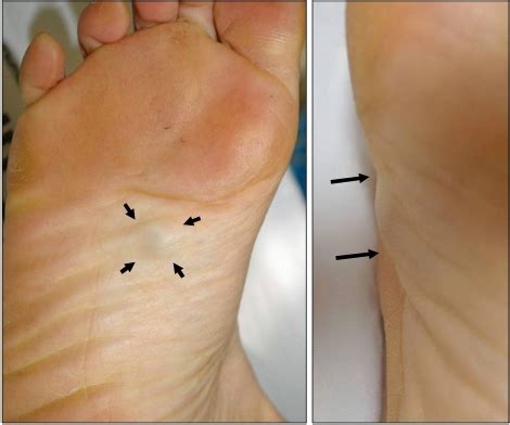 Skin Cancer On Bottom Of Foot