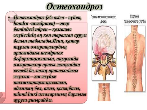 Остеохандроз (г/е osteo - сүйек, hondra -шеміршек) - презентация онлайн