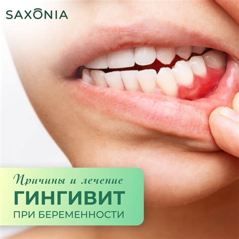 Гингивит при беременности. Причины и лечение в клинике Saxonia