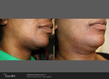 Laser Hair Removal Specialist - Clifton, NJ: NJ Vein Care and ...