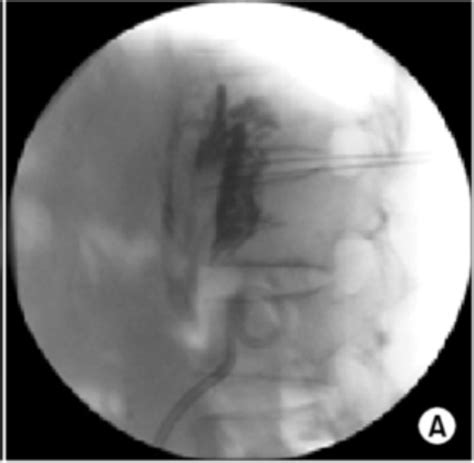 Chemical Neurolysis - Spine specialist doctor in surat | Spine ...