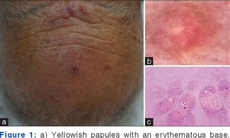Figure 1 from Molluscum contagiosum mimicking sebacious hyperplasia ...