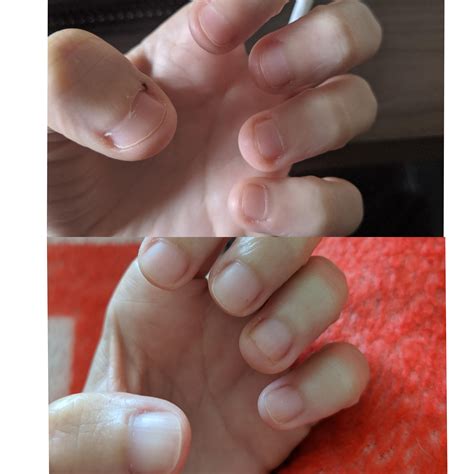 Nail beds do grow back! 4.5 months between the two pictures & I