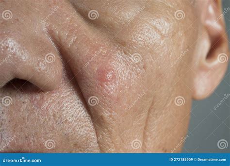 Man with a Big Ugly Pimple on His Cheek Stock Image - Image of acne ...