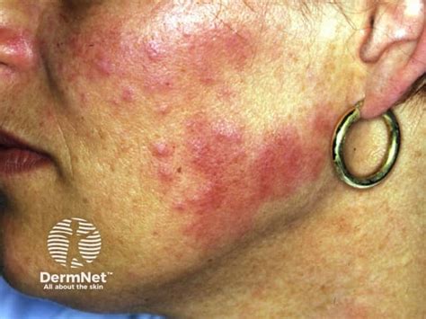 Jessner lymphocytic infiltrate of the skin