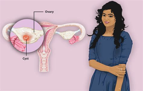 Ovarian cyst and its Homeopathic Treatment | Kidney Failed