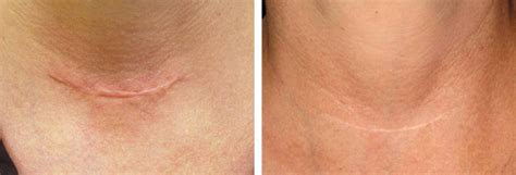 laser  scar removal insight derma clinic