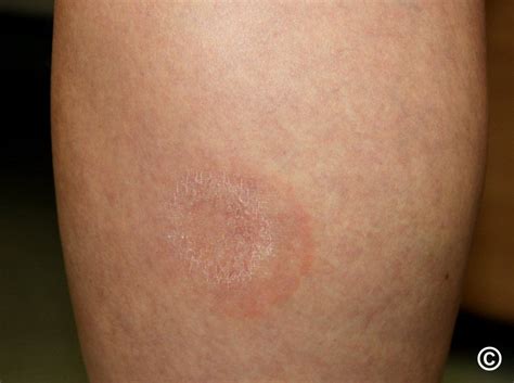 Annular erythema