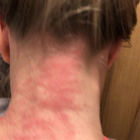Allergic Reaction?? Details in comments : r/AskDoctorSmeeee