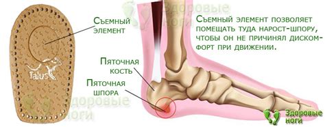 Купить подпяточник при пяточной шпоре со съемным элементом ...