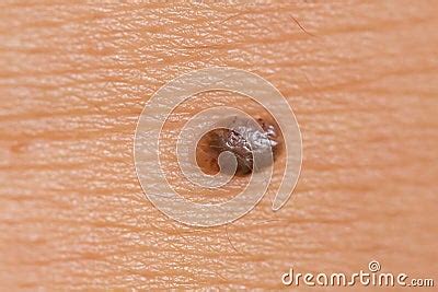 Intradermal Nevus Stock Image | CartoonDealer.com #25491715