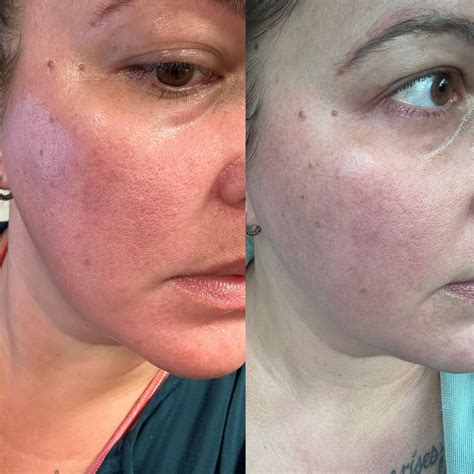 Progress with AzA : r/Rosacea