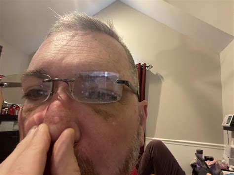 Nose cancer Fixed : r/Dermatology