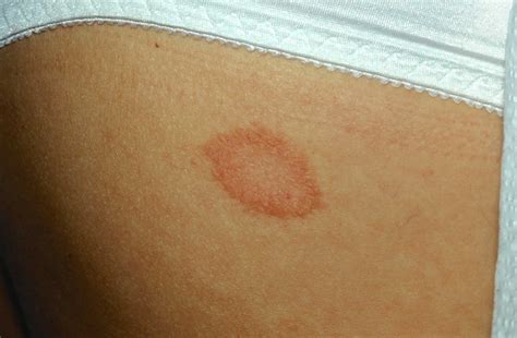 Pityriasis rosea in children causes, symptoms, diagnosis & treatment