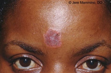 Discoid Lupus Rash On Face