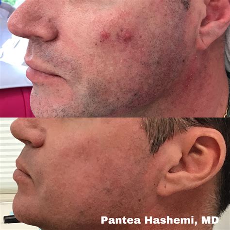 how to eliminate bacne 6