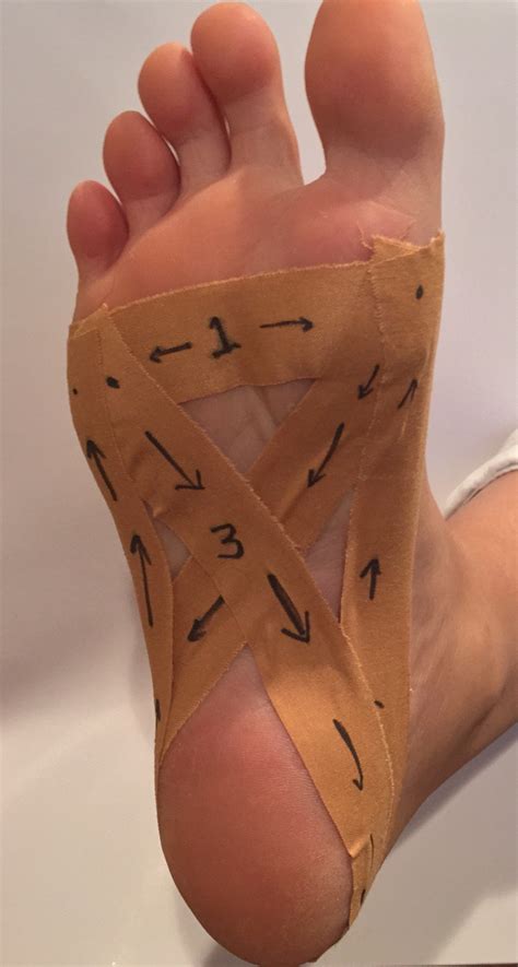 [DIAGRAM] Diagram Of Plantar Fasciitis - MYDIAGRAM.ONLINE