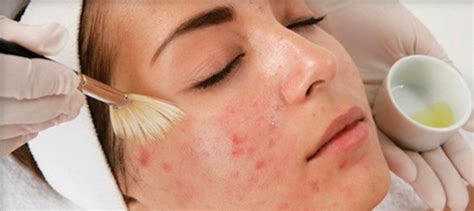 Вульгарные угри, фото и чем лечить в домашних условиях
