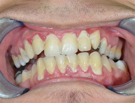 What is Dental Plaque, and How Can I Get Rid of It?
