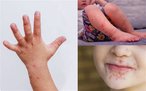 Hand Foot Mouth Disease Current Status Of Hand Foot And Mouth Disease