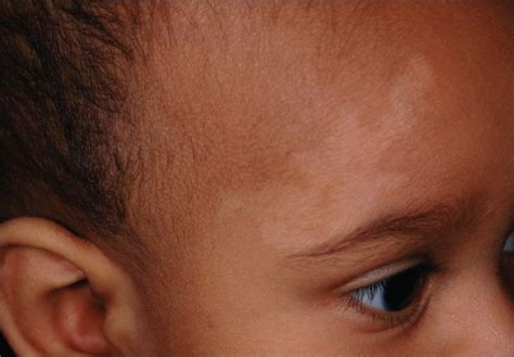 What About This Light-Colored Patch Over an Infant's Brow Rules Out ...