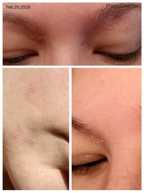 Scaly itchy rash : r/Dermatology