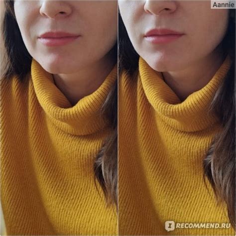 Инъекции полимолочной кислоты (коррекция нижней трети лица полимолочной ...