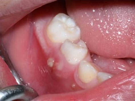 Gengiva Inchada Com Pus - Pus na gengiva perto do dente: tratamento, o que fazer se a gengiva ...