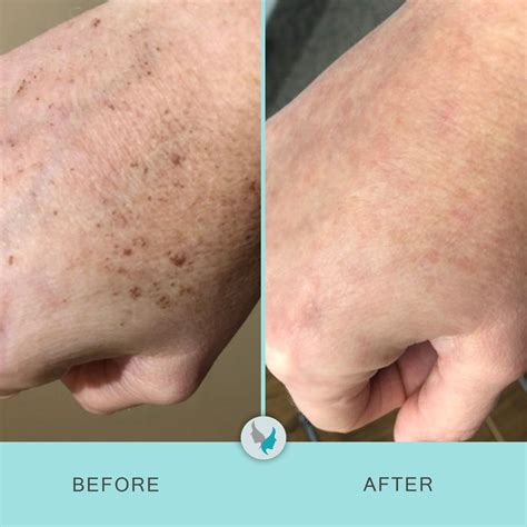 Laser therapy - Seawall Anti-aging Center